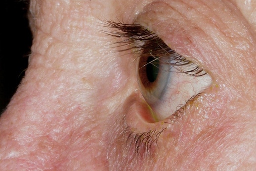 Blefaroplastia