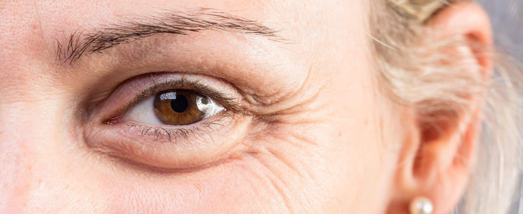 ¿Cómo quitar las bolsas de los ojos?