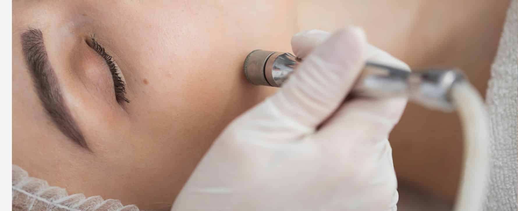 ¿Cómo quitar cicatrices?
