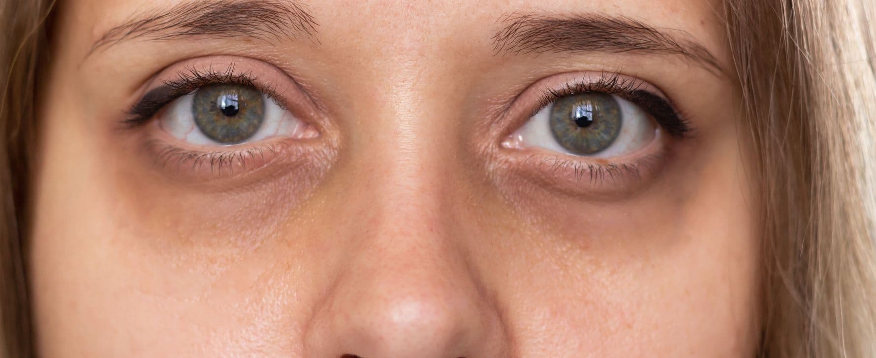 eliminar-las-ojeras-permanente