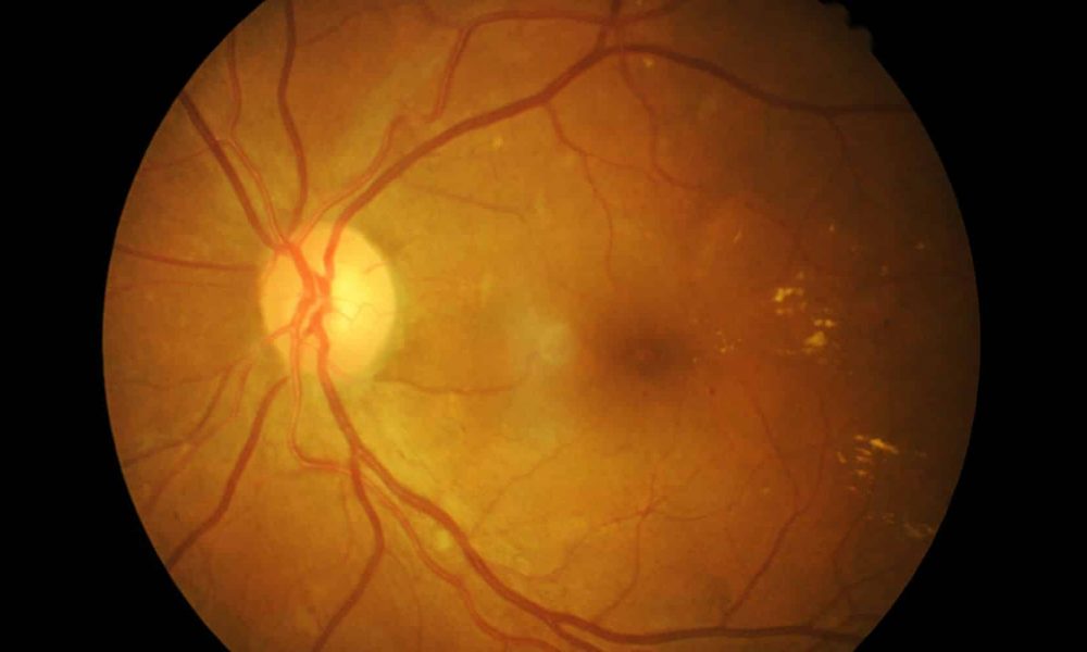 Qué pasa cuando una persona tiene desprendimiento de retina