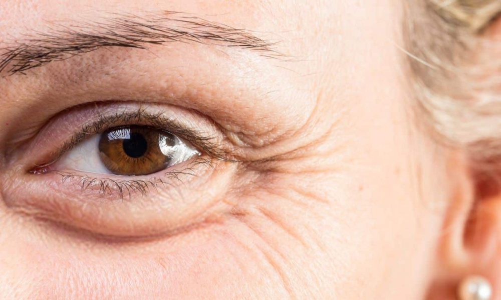 ¿Cómo quitar las bolsas de los ojos?