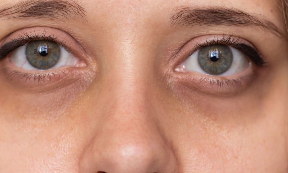 eliminar-las-ojeras-permanente